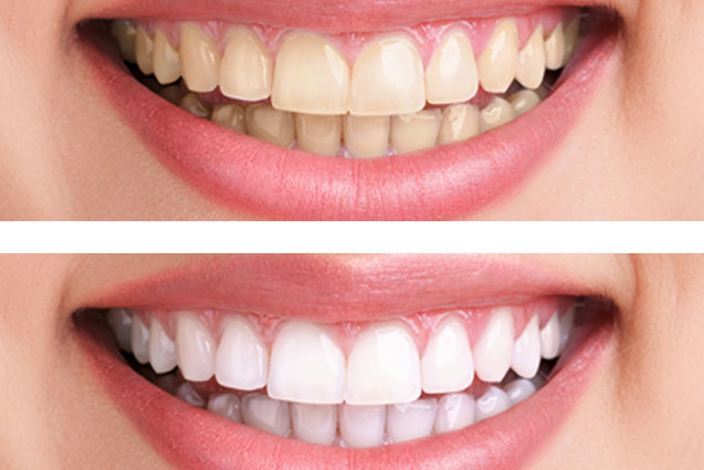Maximizing Teeth Whitening Trays from Your Dentist